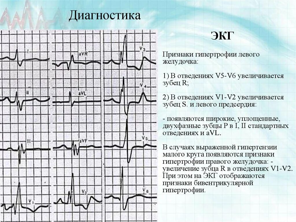 Признаки гипертрофии лж на ЭКГ. Гипертрофия левого желудочка ЭКГ зубец r. Гипертрофия миокарда левого желудочка на ЭКГ. ЭКГ синусовый ритм гипертрофия левого желудочка.