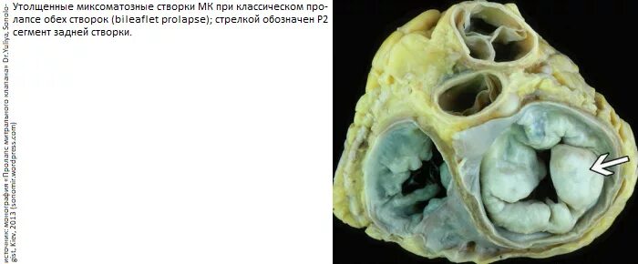 Миксоматозная дегенерация МК. Миксоматозная дегенерация клапана. Миксоматозная дегенерация митрального клапана ЭХОКГ. Миксоматозная дегенерация створок митрального клапана код мкб 10.