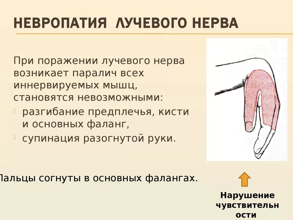 Невропатия форум невропатия форум. Клинические симптомы повреждение лучевого нерва. Клинические проявления нейропатии лучевого нерва. Клинические проявления поражения лучевого нерва. Невропатия лучевого нерва клиника.