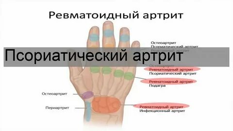 Признаки артрита у мужчин