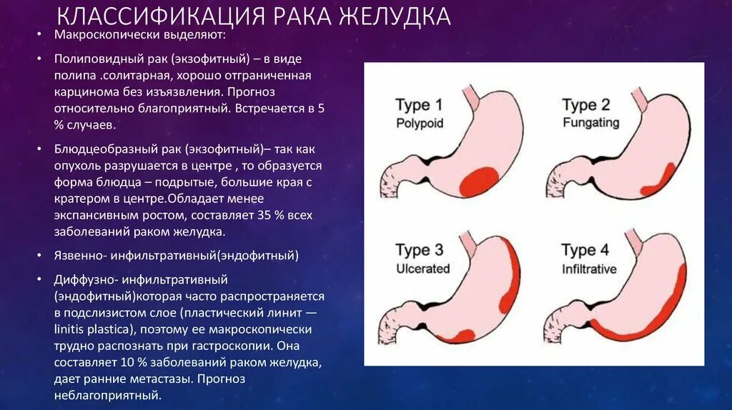 Рак желудка 4 сколько живут. Новообразование в желудке. Опухоль пилорического отдела. Злокачественная опухоль желудка.