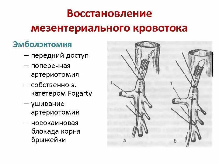 Острое мезентериальное кровообращение. Система верхней брыжеечной артерии. Эмболэктомия катетером Фогарти. Ствол верхней брыжеечной артерии. Тромбоз верхней брыжеечной артерии.