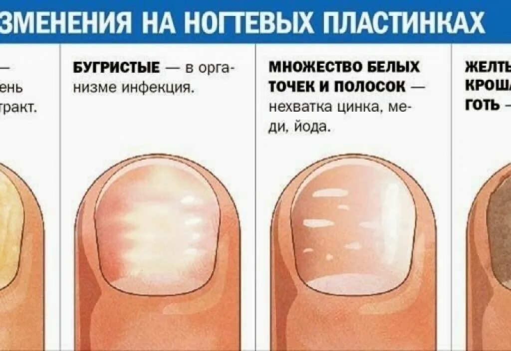 Почему форма ногтей. Деформация ногтевой пластины. белая ногтевая пластина. белые пятна на ногтевой пластине. деыормация ногтеврй поасиины.