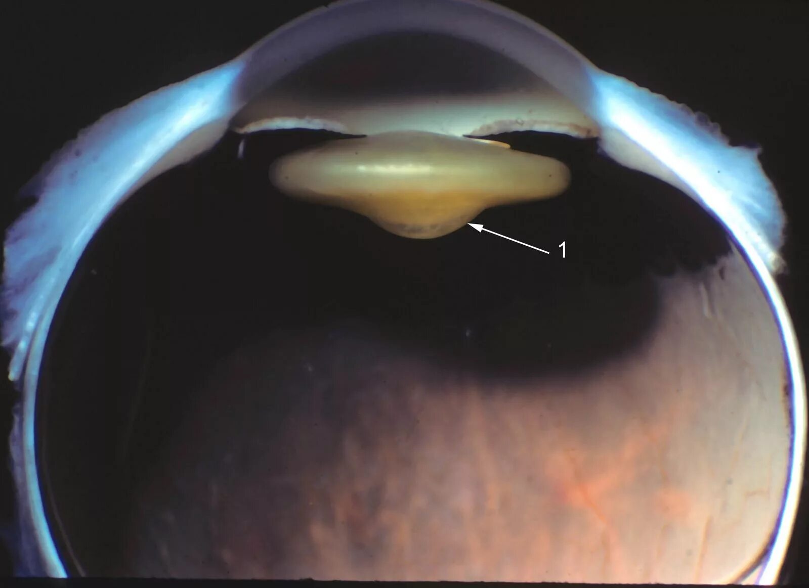 Интракапсулярная экстракция катаракты. Строение хрусталика гистология. Швы хрусталика. Швы хрусталика. Операция на хрусталик глаза.