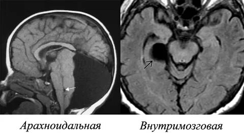 Арахноидальная киста головного мозга