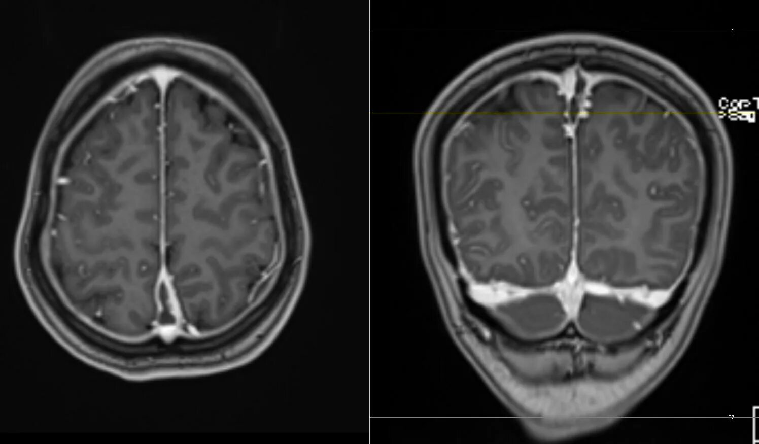 Гипоплазия правого поперечного синуса. Менингиома поперечного синуса. Тромбоз поперечного синуса мрт. Менингиома поперечного синуса мрт. Опухоль поперечного синуса.