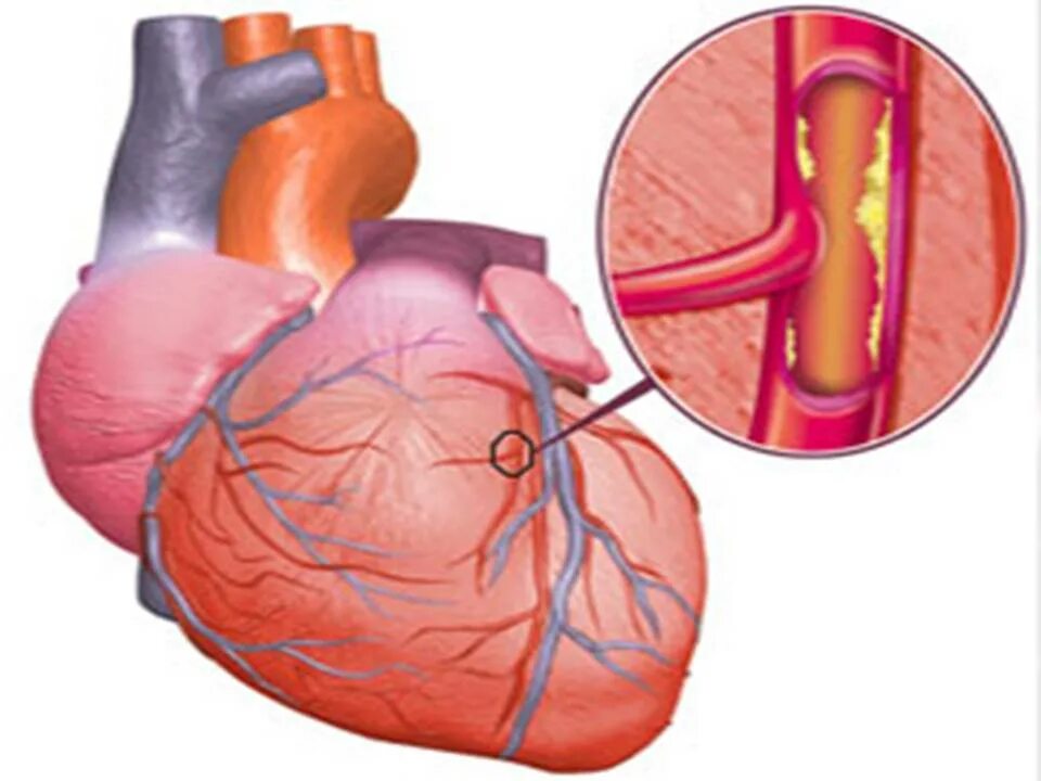 Ишемия крови. ИБС атеросклероз коронарных артерий. Атеросклероз ИБС стенокардия. ИБС стенокардия атеросклероз симптомы.