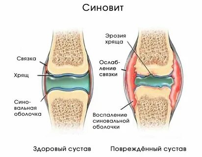 Жидкий сустав