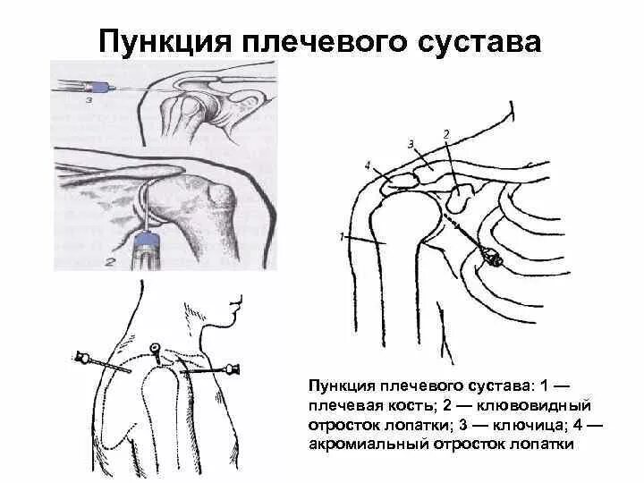 Артротомия плечевого сустава. Точки пункции плечевого сустава топографическая анатомия. Пункция локтевого сустава схема. Пункция плечевого сустава схема. Пункция плечевого сустава точки пункции.