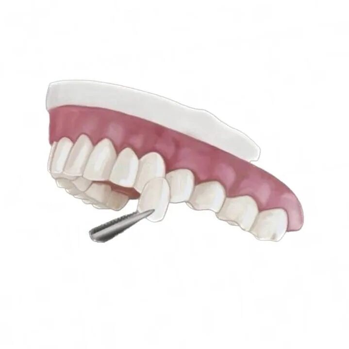 Протезирование зубов инвалиду 1 группы. Виниры для зубов стоматологические керамика.