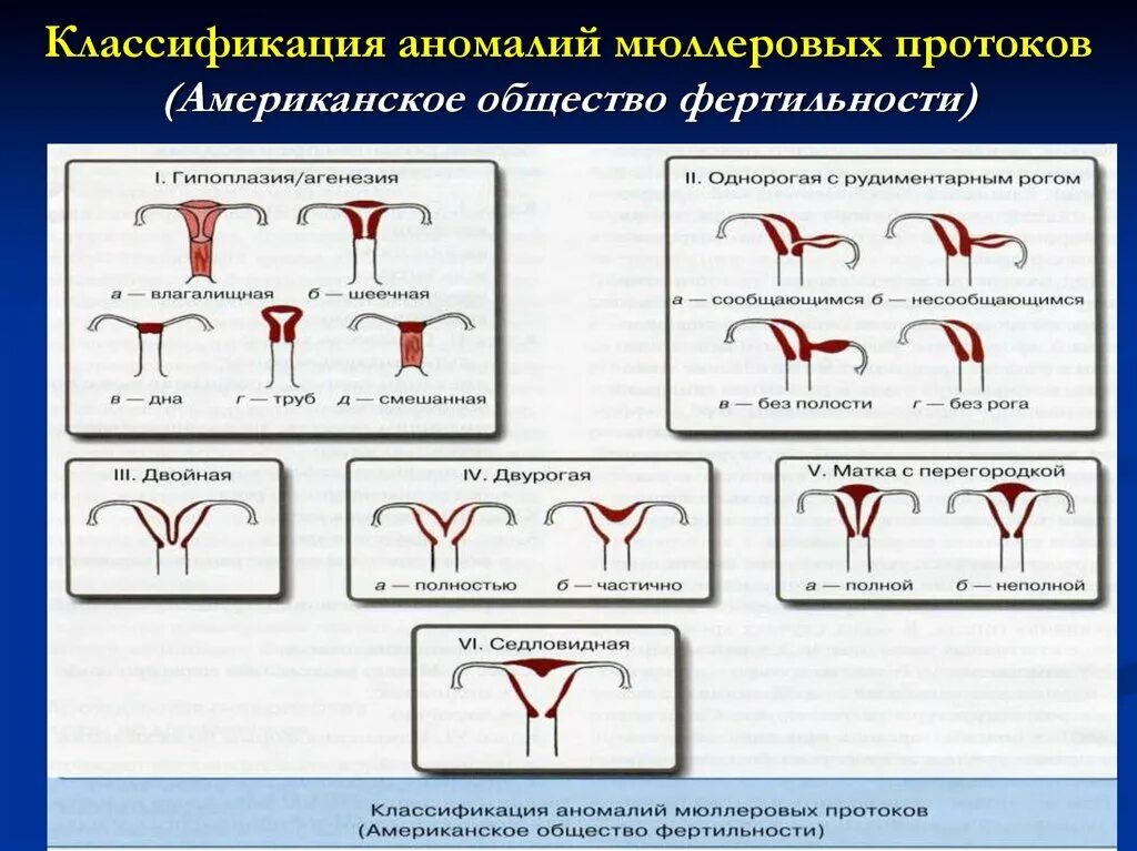 Классификация аномалий мюллеровых протоков. Аномалии развития мюллеровых протоков. Классификация пороков развития мюллеровых протоков. Классификация пороков развития половых органов.