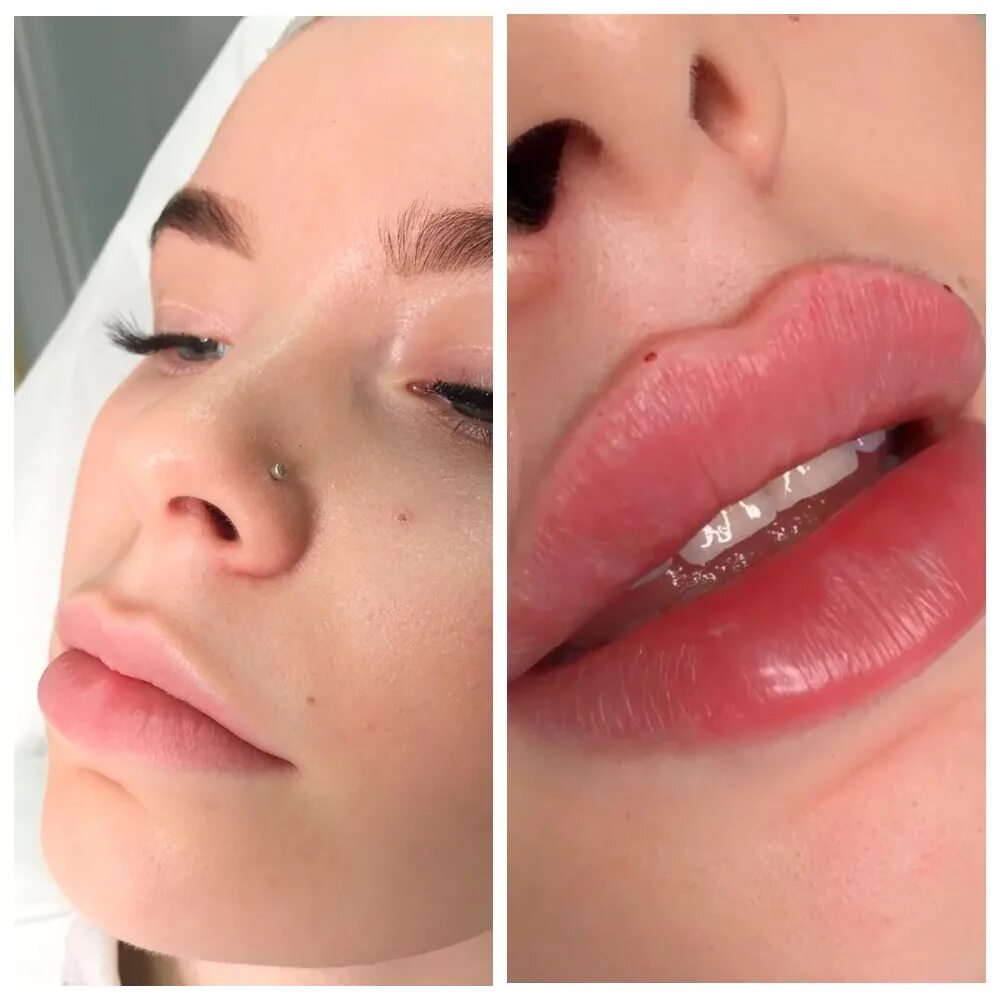 Контурирование губ гиалуроновой кислотой. После увеличения губ нет эффекта. Коррекция губ гиалуроновой кислотой 1 мл. Гиалуроновая кислота в губы 1 мл. После увеличения губ нет эффекта.