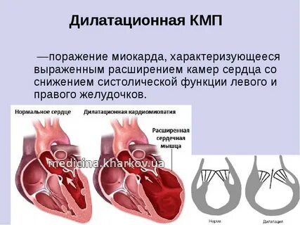 Дилатация левого желудочка и правого желудочка