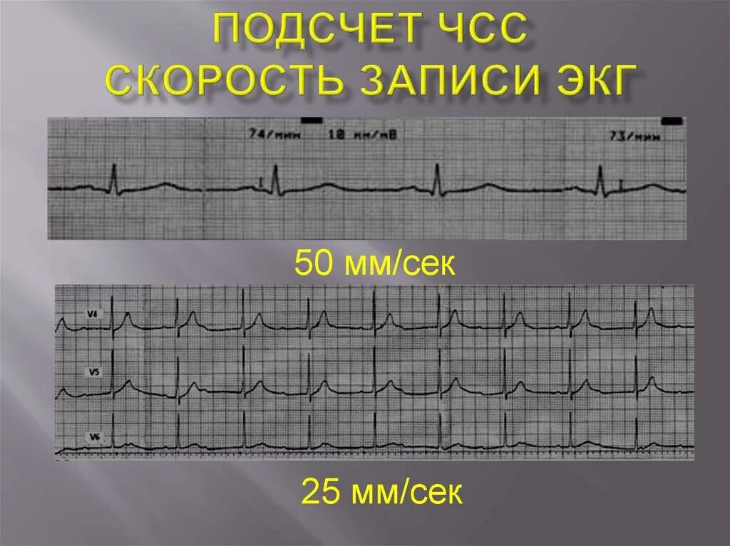 Как измерить частоту сердечных. Скорость записи ЭКГ 50 мм с. ЧСС по ЭКГ 25 мм. Скорость записи ЭКГ 25 мм с. Скорость записи 50 мм в сек ЭКГ.