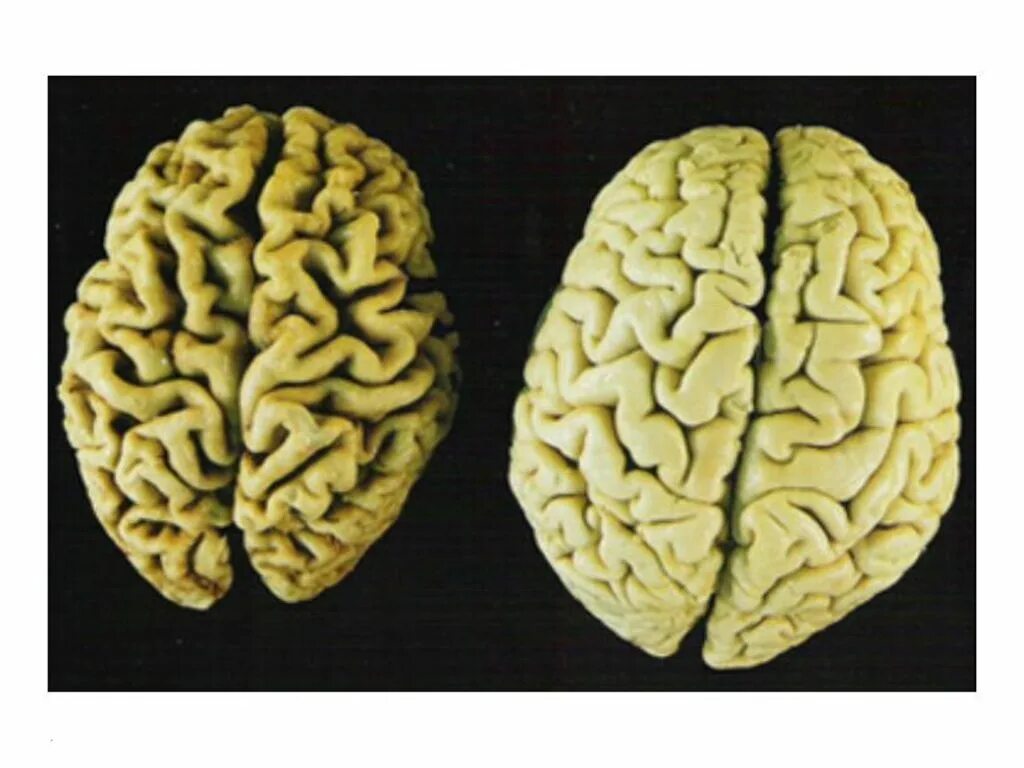 Brain mass