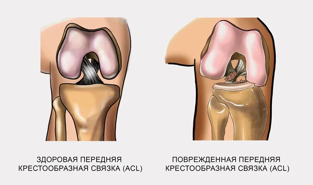 Травма связок сустава. Разрыв связок ПКС коленного сустава. Повреждение передней крестообразной связки коленного сустава. Разрыв передней крестообразной связки. Надрыв крестообразных связок.