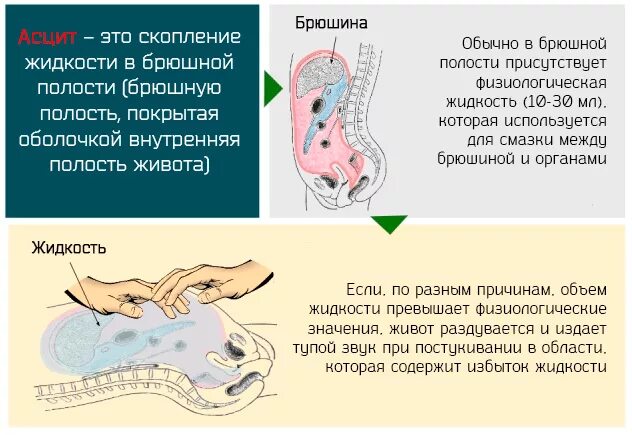 Асцит почему