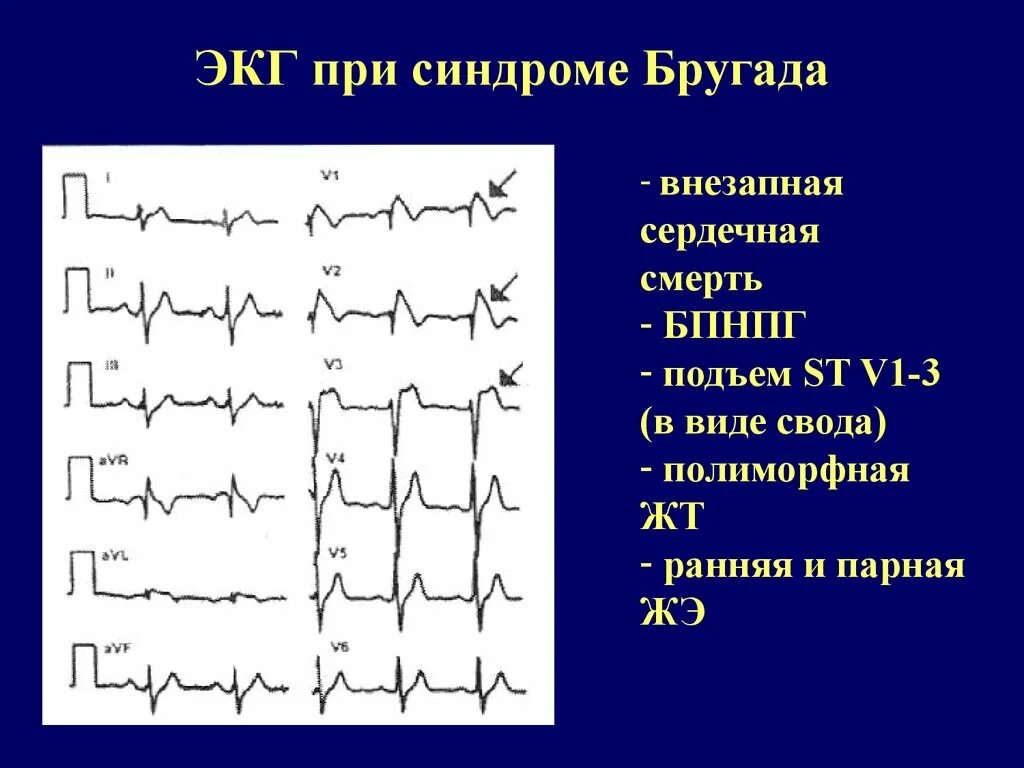 Синдром бругада экг критерии. Синдром бругада тип 2 экг. Характерные клинические проявления синдрома бругада. Синдром бругада тип 2. Экг-критерии синдрома бругада 3 типа.