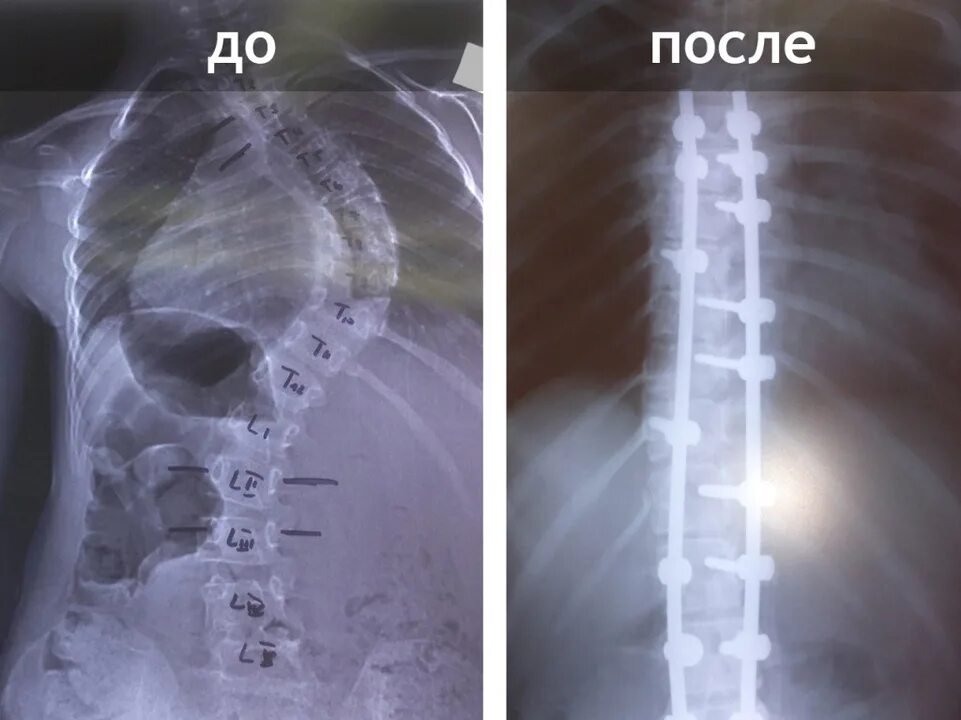 Сколиоз позвоночника операция. Сколиоз операция рентген. Металлоконструкция в позвоночнике. Операция на позвоночник с металлоконструкцией инвалидность