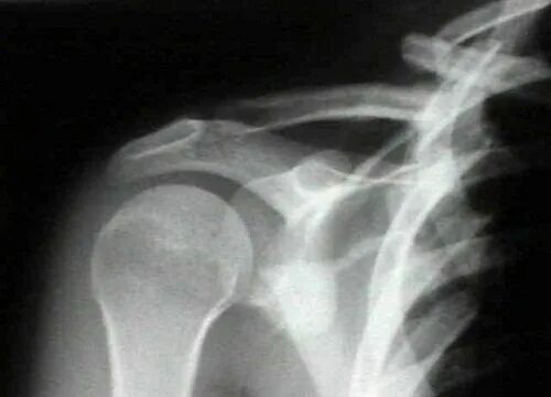 самая крепкая кость у человека. самые хрупкие кости у человека. ломкость костей. остеопороз характерен для 1 правильный. насколько крепкие кости человека.