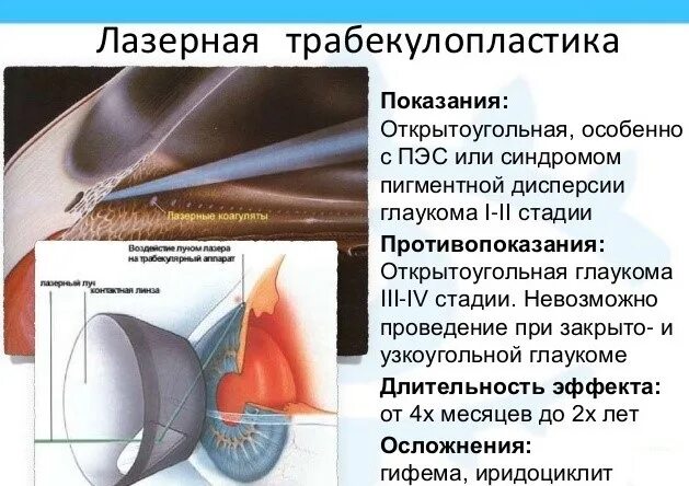 Операция глаукома лазерная трабекулопластика. Первичная открытоугольная глаукома осложнения. Селективная лазерная Трабе. Селективная лазерная трабекулопластика глаза. Глаукома суть операции