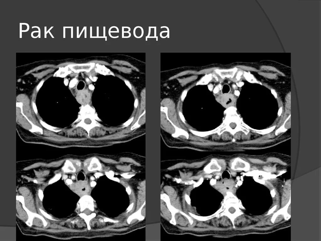 Кт при опухоли пищевода. Образование пищевода на кт. Кт пищевода и желудка