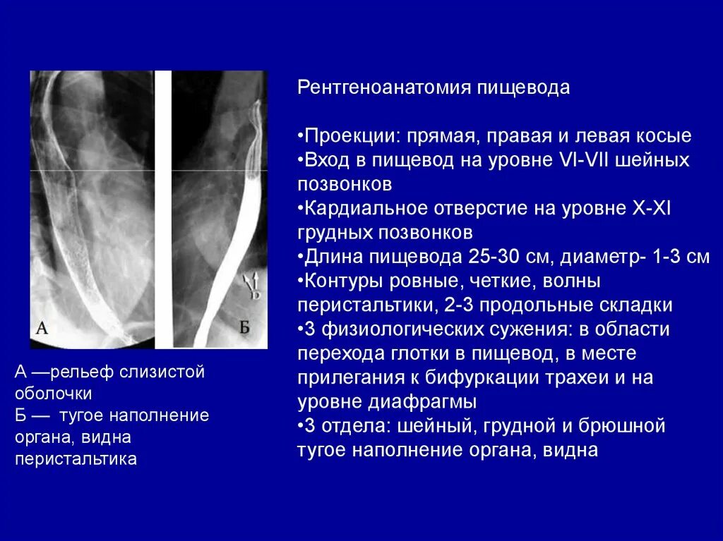 Как подготовиться к рентгену пищевода. Анатомия пищевода рентген. рентгеноскопия пищевода норма. анатомические сужения пищевода рентген.