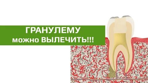 Гранулез