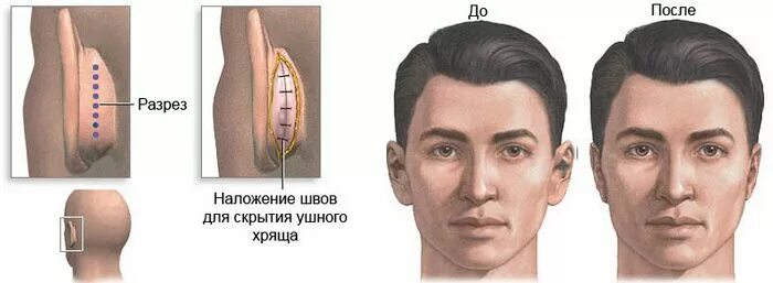 Уши до и после операции Otoplasty Ear Surgery in Las Vegas, NV Dr. Robert J. Troell