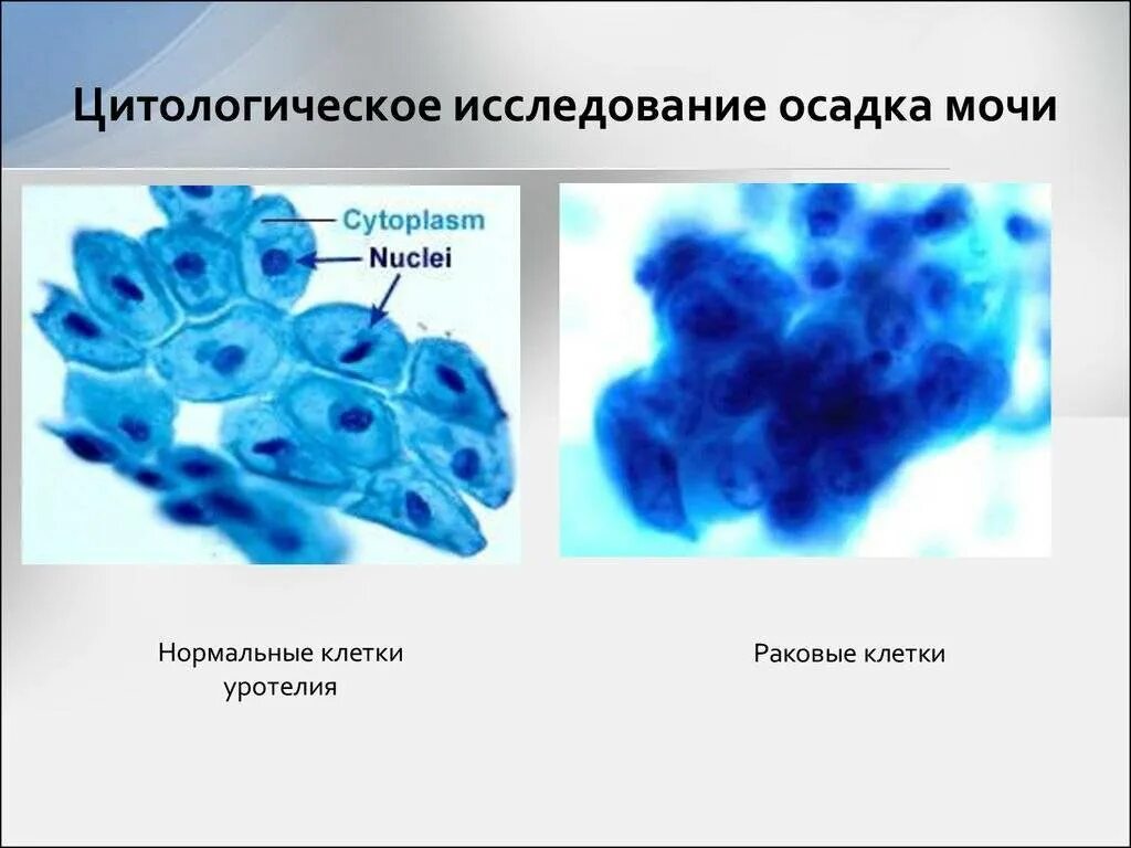 Обследование цитологическое исследование. Цитологическое исследование осадка мочи. цитологическое исследование опухоли. цитологическое исследование методика. цитологический метод исследования.