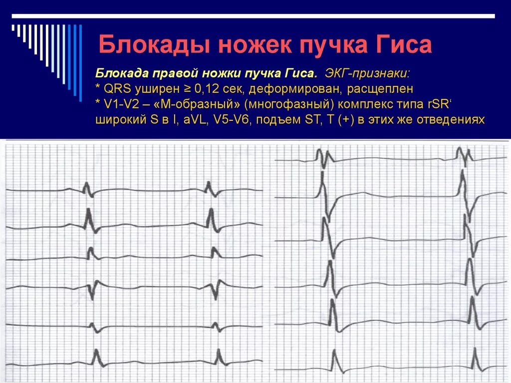 Комплекс блокада. Блокада пучка Гиса на ЭКГ. ЭКГ критерии блокады ножек пучка. Блокады пучка Гиса на ЭКГ признаки. Признаки блокад ножек Гиса на ЭКГ.