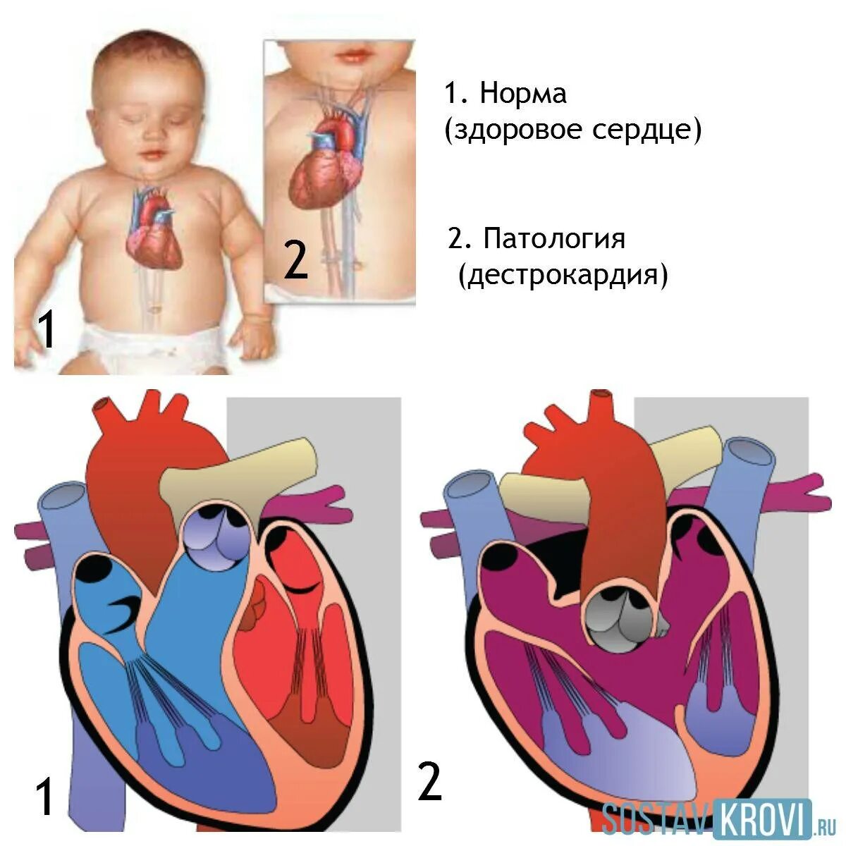 Окно в сердце у ребенка. Сердце ребенка. Расположение сердца у детей.