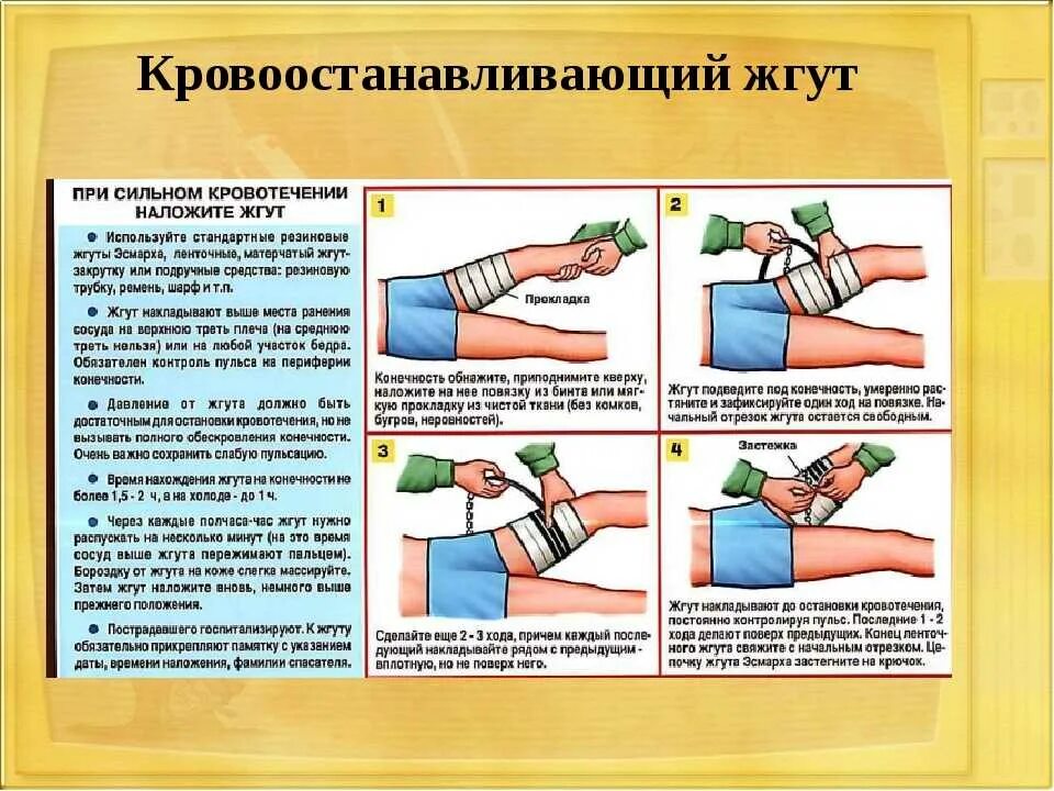 Пострадавшему с сильным наружным кровотечением. Наложение жгута для остановки кровотечения применяется при. Методика наложения кровоостанавливающего жгута на конечность. Наложение артериального жгута алгоритм. Наложение жгута на конечность при кровотечении.