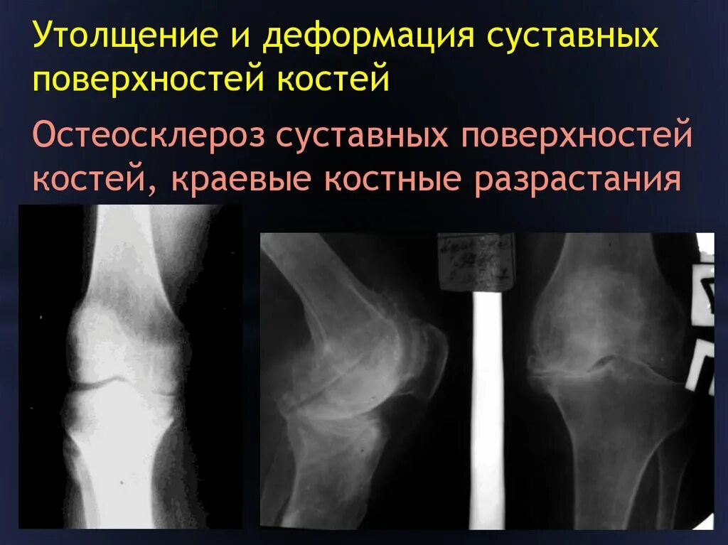 Как лечить остеосклероз. Остеосклероз плечевой кости кт. остеосклероз берцовой кости. остеосклероз головки плечевой кости. локальный остеосклероз.