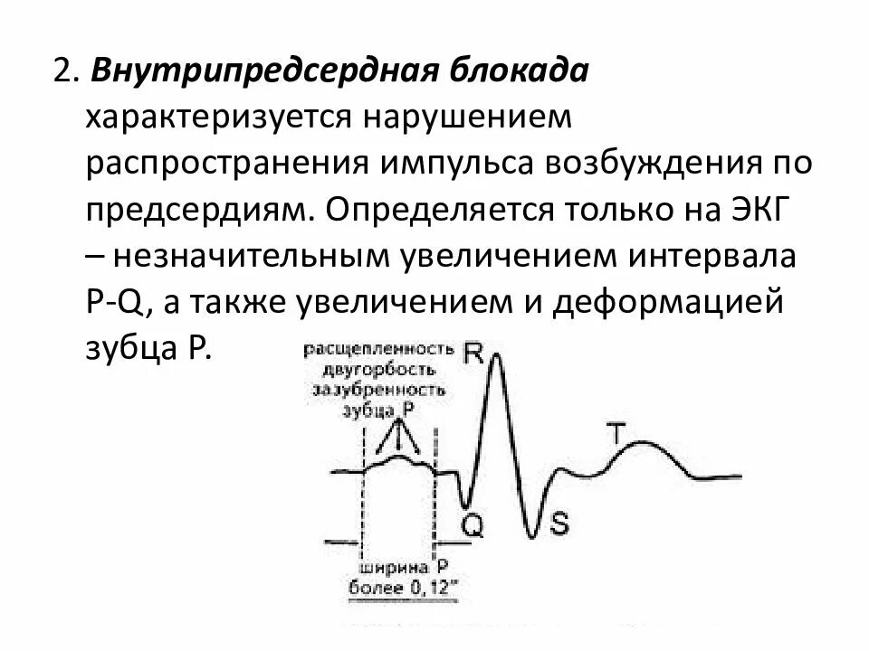 Внутрипредсердная блокада 1 степени что это значит. Внутрипредсердные блокады на экг. внутрипредсердная блокада 3 степени экг. внутрипредсердная блокада на экг характеризуется. экг признаки предсердной блокады.