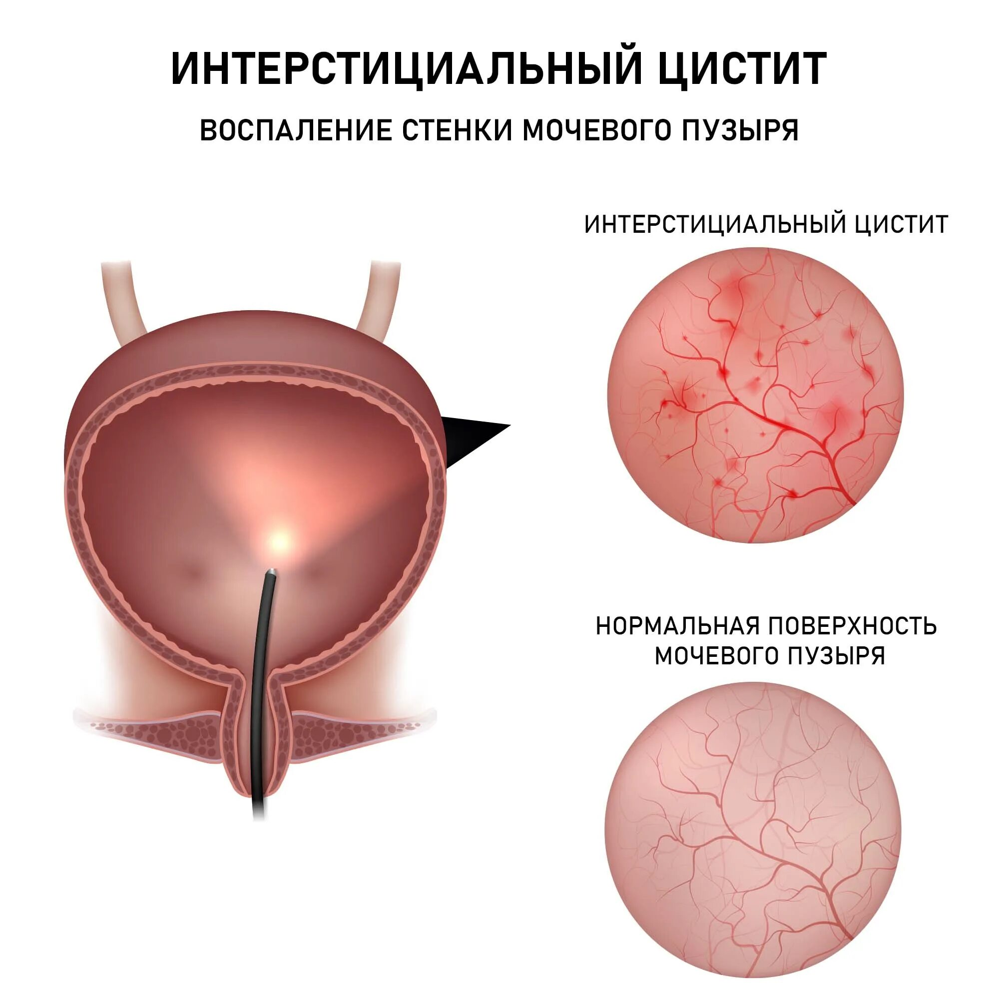 После лучевой цистит. Геморрагический цистит цистоскопия. Эндометриоз мочевого пузыря цистоскопия.