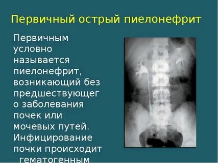 Пиелонефрит из за чего возникает