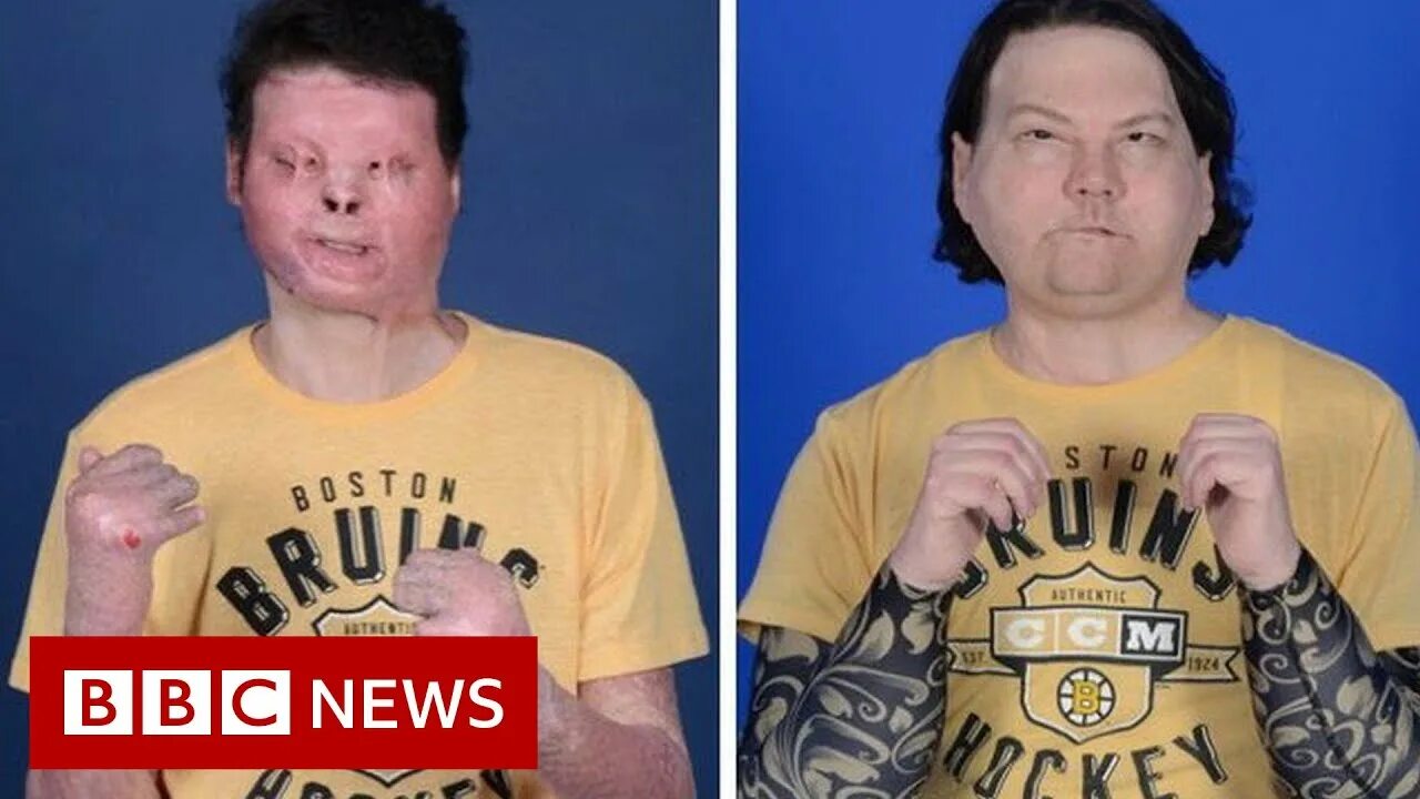 Man has world’s first successful face and double hand transplant - The Standard 