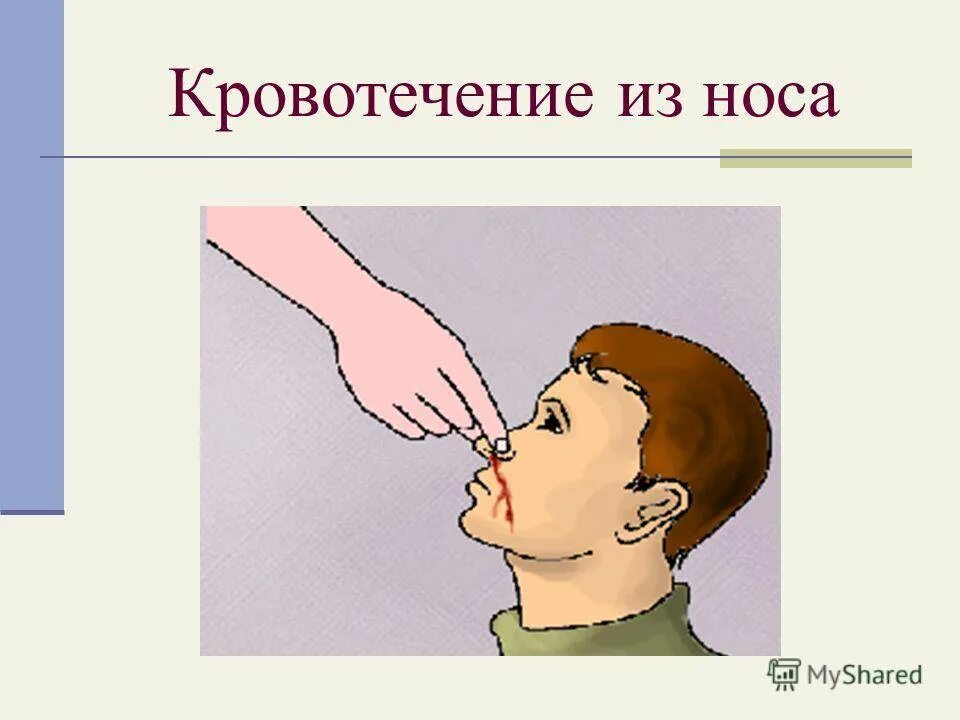 С носовым кровотечением следует. Кровь из носа кровотечение.