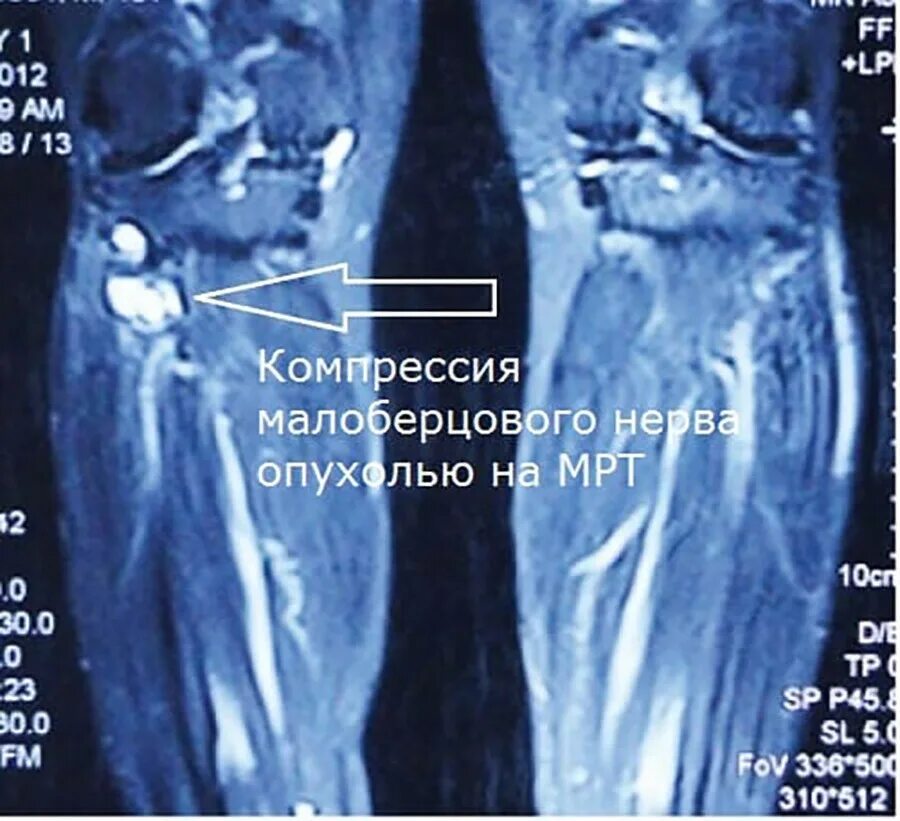 Невролиз малоберцового нерва. УЗИ малоберцового нерва. Сдавление малоберцового нерва.