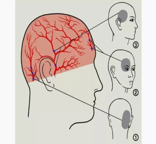Голова левая сторона затылок. Пульсирующая боль в голове за ухом слева. Болит голова справа за ухом. Боль за правым ухом в затылочной части головы. Головная боль справа за ухом.
