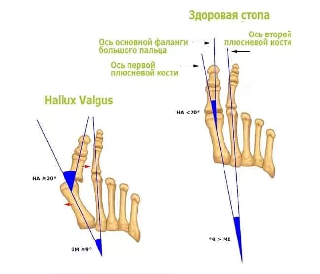 Фаланги стопы. Косточка фаланги большого пальца стопы. Косточка на большом пальце ноги анатомия. Фаланги 1 пальца стопы анатомия. Большой палец стопы анатомия кости.