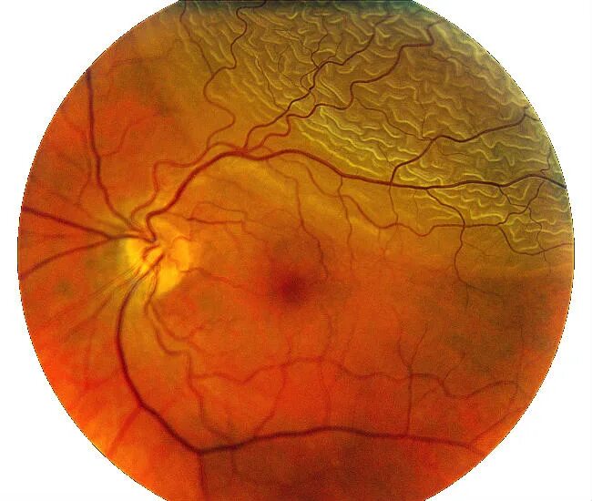 Регматогенная отслойка сетчатки. Экссудативная отслойка сетчатки. Отслойка сетчатки офтальмоскопия. Разрыв сетчатки (retinal tear).