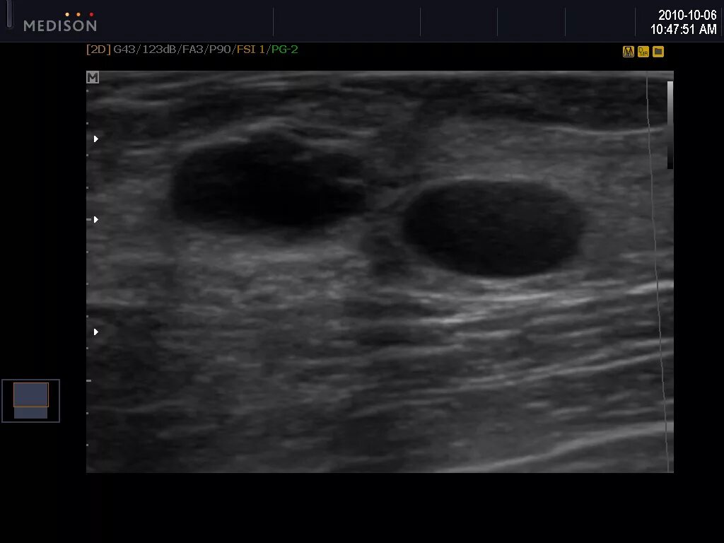 Саркома на узи. Аппарат УЗИ Samsung SONOACE r7. Эхограмма кисты молочной железы. Аденофиброма молочной железы УЗИ. Фиброма молочной железы на УЗИ.