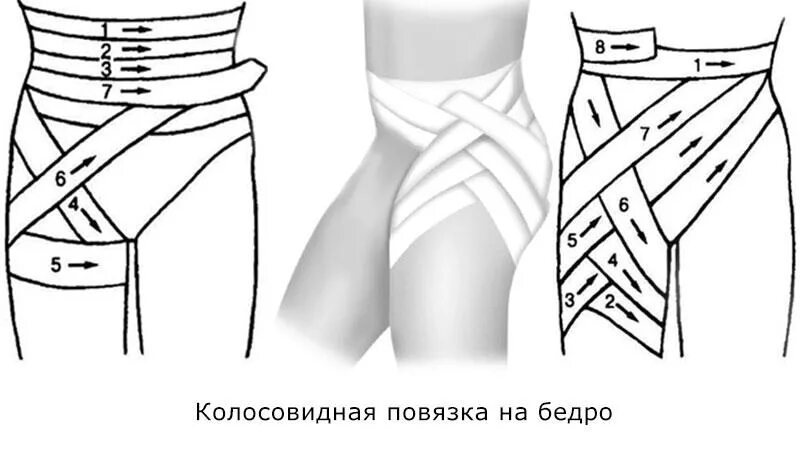 Как перебинтовать эластичным. Колосовидная повязка на тазобедренный сустав. колосовидная перевязка на бедро. колосовидная на тазобедренный сустав. перевязка бедра эластичным бинтом.