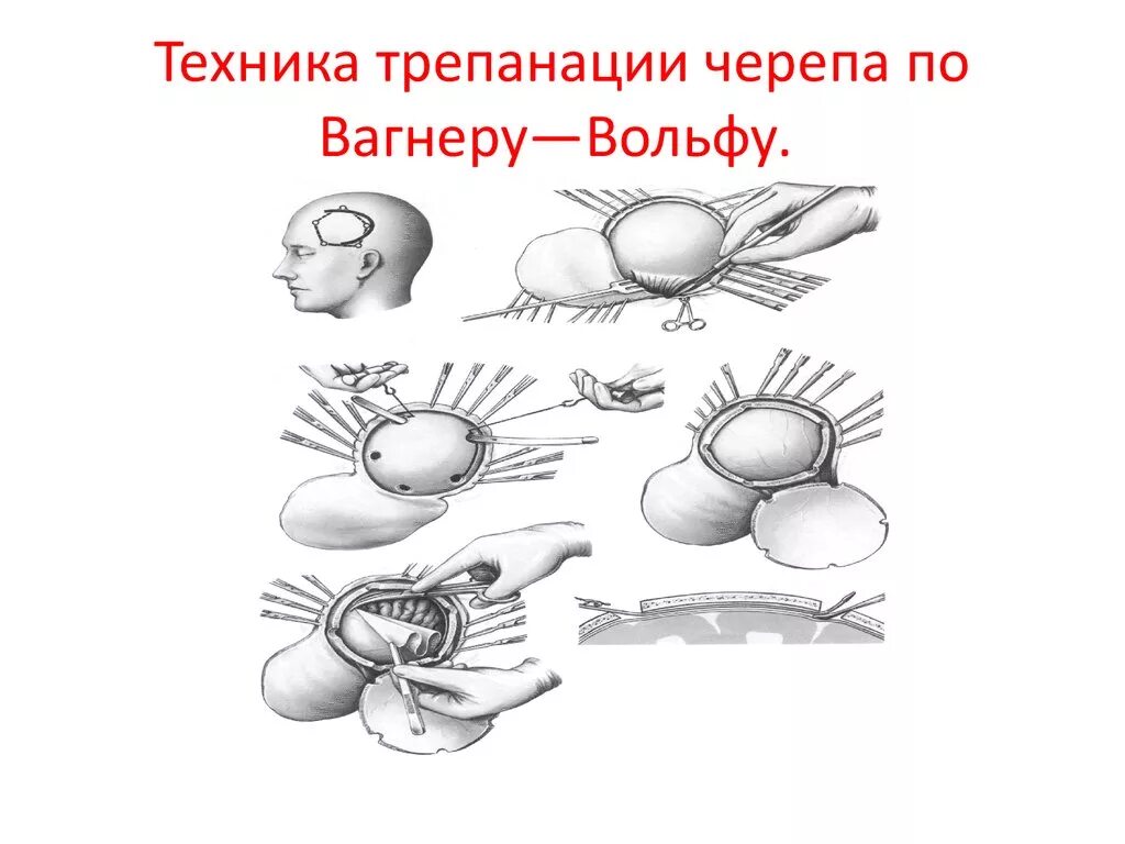 Техника трепанации черепа по вагнеру вольфу. Техника трепанации черепа по вагнеру вольфу. Трепанация по вагнеру вольфу. Костно-пластическая трепанация черепа этапы. Декомпрессивная трепанация по кушингу.