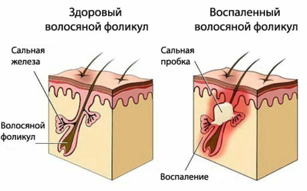 Закупоренная сальная железа на голове. Воспаление волосяного фолликула. Воспаленные сальные железы. Волосяной фолликул и сальная железа.