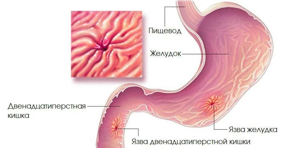 Язва желудка симптомы и лечение у женщин. Язва желудка симптомы и лечение у женщин