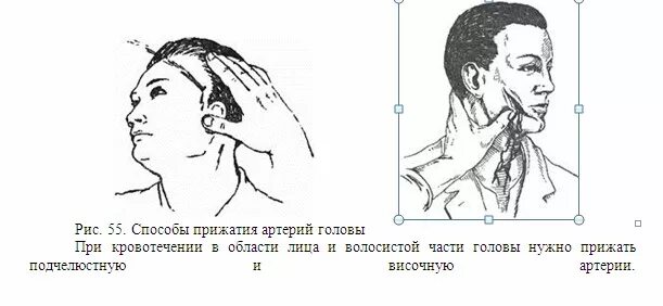 Точка пальцевого прижатия лицевой артерии. Остановка кровотечения лицевой артерии. Пальцевое прижатие челюстной артерии. Остановка артериального кровотечения из раны лица..