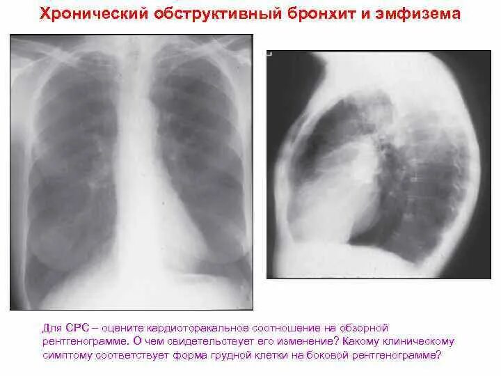 Эмфизема хронического бронхита. Хронический бронхит рентгенологическая картина. Хронический обструктивный бронхит рентген. Форма грудной клетки при хроническом обструктивном бронхите. Рентген грудной клетки ХОБЛ.